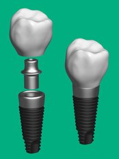 Implant Dentist Consultation - Peru Dental