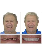 Dental Implants - Smiles Peru