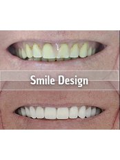 DSD - Digital Smile Design - Smiles Peru