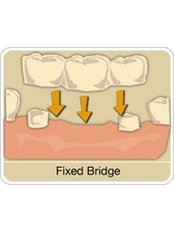 Fixed Bridge - Smiles Peru