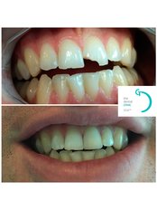 Chipped Tooth Repair - The Dental Clinic & GT Concept Asociados