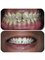 Bonifacio Dental Angeles City Dentist Pampanga PHP - Teeth Whitening  