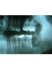 Wisdom Tooth Extraction - Bonifacio Dental Angeles City Dentist Pampanga PHP