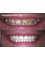 Bonifacio Dental Angeles City Dentist Pampanga PHP - Zirconia Full Ceramic Crowns  
