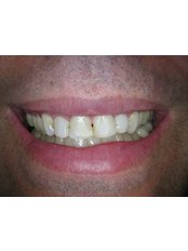 Porcelain Veneers - Bonifacio Dental Angeles City Dentist Pampanga PHP