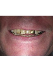 Gold Crown - Bonifacio Dental Angeles City Dentist Pampanga PHP