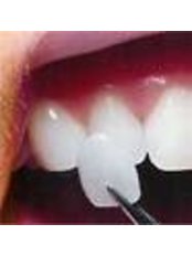 Veneers - Bonifacio Dental Angeles City Dentist Pampanga PHP