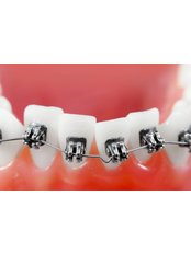 Braces - Northern Dental Specialists