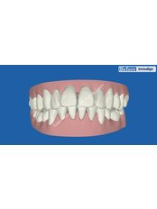 Braces - Smile Make Over Dental & Aesthetic Center