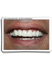Veneers - Smile Make Over Dental & Aesthetic Center