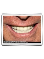 Dental Crowns - Smile Make Over Dental & Aesthetic Center