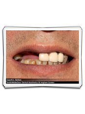 Dental Implants - Smile Make Over Dental & Aesthetic Center