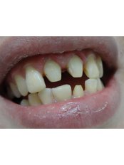 Dental Crowns - Winsome Smile Today