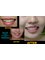 Winsome Smile Today - emax -the glass ceramic crown So thin yet so durable 