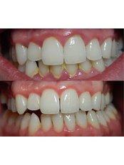 GUM Treatment: Deep scaling and polishing of affected teeth - Winsome Smile Today