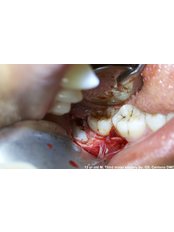 Wisdom Tooth Extraction - G.S. Centeno Dental Clinic