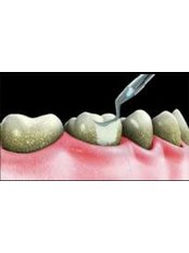 Teeth Cleaning - Cabahug Dental Office