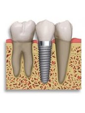 Dental Implants - Cabahug Dental Office