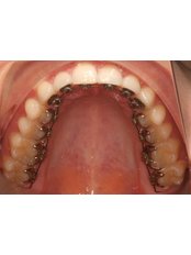 Orthodontist Consultation - The Dental Hub