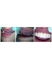 Dental Implants - Pangasinan Dental Implant & Oral Surgery