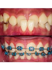 Orthodontics - Smile Depot Dental Clinic