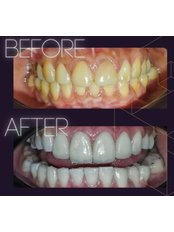 Veneers - Smile Depot Dental Clinic