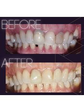 Dental Crowns - Smile Depot Dental Clinic
