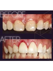 Gum Contouring and Reshaping - Smile Depot Dental Clinic