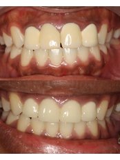 Dental Crowns - Premier Dental Care Solutions