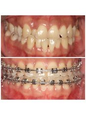 Braces - Premier Dental Care Solutions