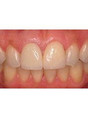 Dental Crowns - Dentcare & Therabreath Center
