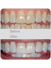Teeth Whitening - Dentcare & Therabreath Center