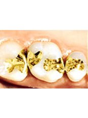 Gold Inlay or Onlay - Dentcare & Therabreath Center
