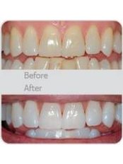Laser Teeth Whitening - Dentcare & Therabreath Center