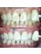 Affinity Dental Clinics Makati - Teeth Whitening Before and After 