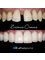 Affinity Dental Clinics Makati - Zirconia Crowns Before and After 