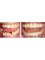 Bel-Air Dental Care - Full Mouth Crowns 