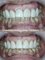 Bel-Air Dental Care - Veneers 
