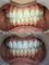 Bel-Air Dental Care - Emax Crowns bleach shade 