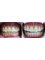 Bel-Air Dental Care - All Porcelain Crowns 