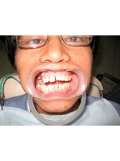 Veneers - Maximo A. Lim Dental Clinic
