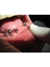 Overdentures - My Dental Space