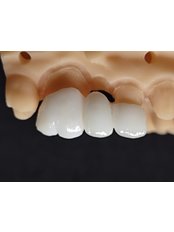 Dental Bridges - Flores Dental PH