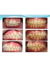 Orthodontist Consultation - Healthy Teeth Happy Family Wellness Center