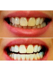 Teeth Whitening - Oraderm Care Clinic