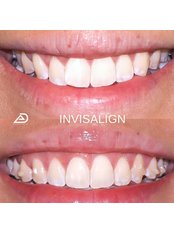 Invisalign™ - Elevate Dental Greenhills