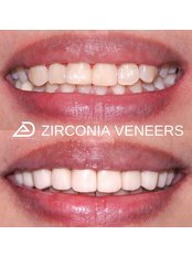 Veneers - Elevate Dental Greenhills