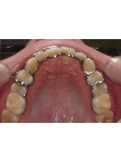 Orthodontic Retainer - Dental Clinic - Dr. Deborah Manugas-Ramos