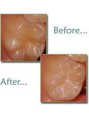 Dental Sealant - Doctors Ocariza Dental Clinic