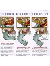 TMJ - Temporomandibular Joint Treatment - Doctors Ocariza Dental Clinic